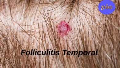 Folliculitis Temporal